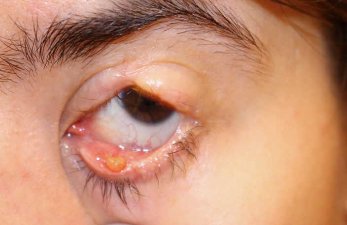 Ligneous Conjunctivitis